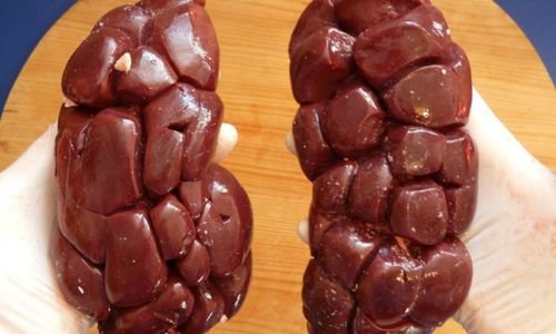 Hypertension & Diabetes